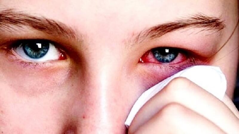 Bệnh Đau Mắt Đỏ Có Nguy Hiểm Không? Nguyên Nhân Và Cách Điều Trị Như Thế Nào?