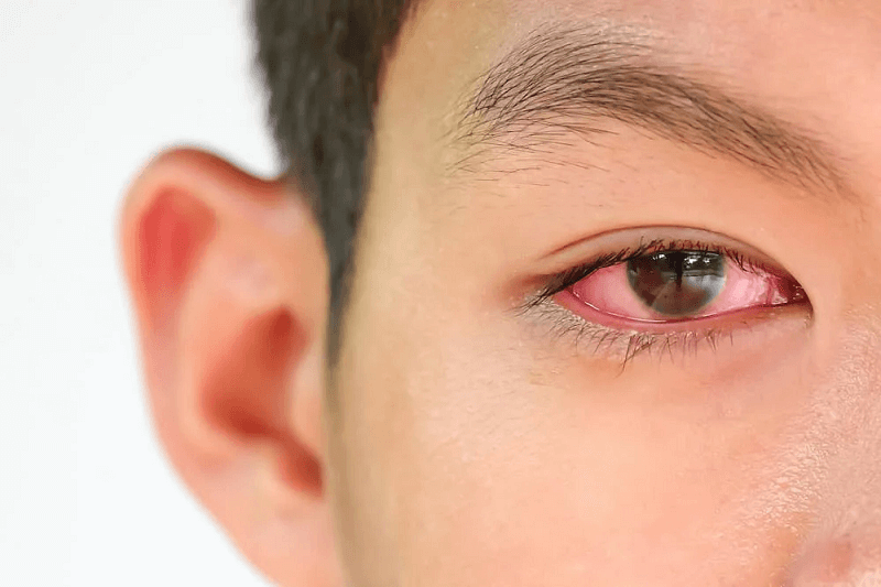 Bệnh Đau Mắt Đỏ Có Nguy Hiểm Không? Nguyên Nhân Và Cách Điều Trị Như Thế Nào?