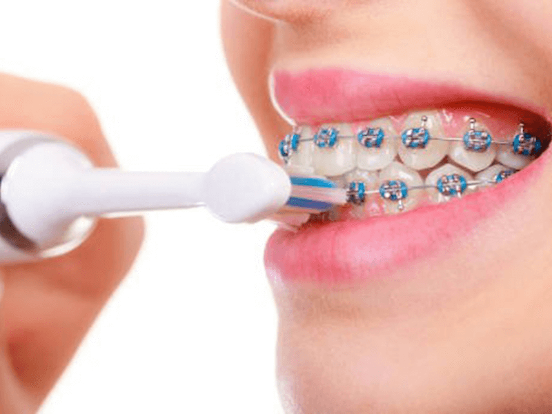 Niềng răng dùng bàn chải điện được không? Top 3 bàn chải điện cho người niềng răng