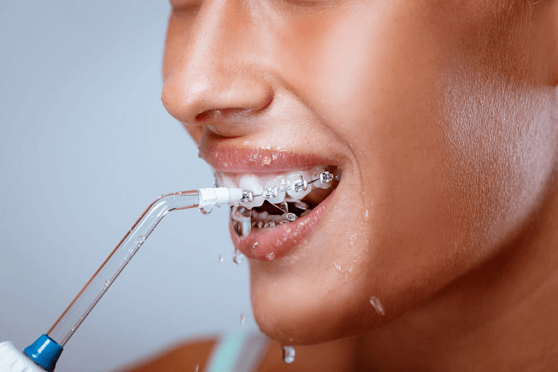 Niềng răng dùng bàn chải điện được không? Top 3 bàn chải điện cho người niềng răng