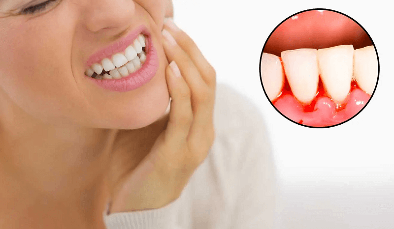 Tại sao đánh răng hay bị chảy máu chân răng? 5 Cách khắc phục chảy máu chân răng đơn giản, hiệu quả