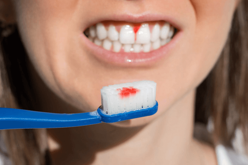 Tại sao đánh răng hay bị chảy máu chân răng? 5 Cách khắc phục chảy máu chân răng đơn giản, hiệu quả