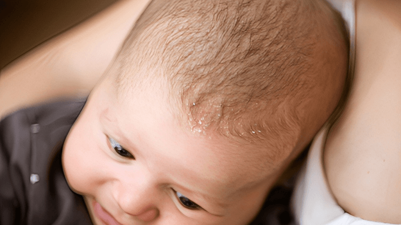 Cứt trâu ở trẻ sơ sinh xuất hiện khi nào? 7 cách trị cứt trâu ở trẻ sơ sinh dứt điểm an toàn