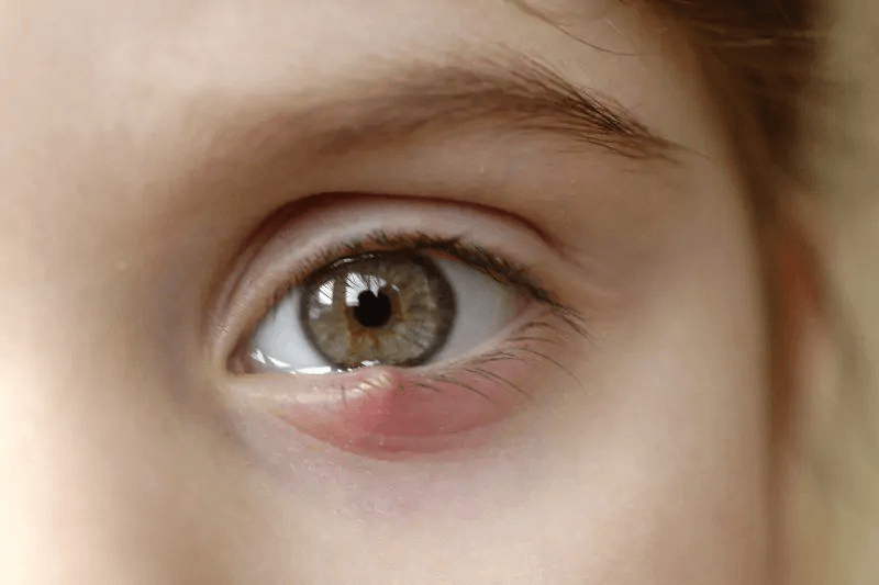 Bị nổi mụt lẹo ở mắt phải làm sao? 7 Cách chữa lẹo mắt tại nhà đơn giản, dễ thực hiện