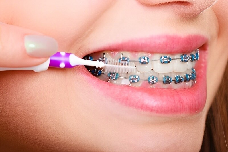Chăm sóc răng miệng toàn diện khi niềng răng: Bí kíp "vàng" cho nụ cười rạng rỡ