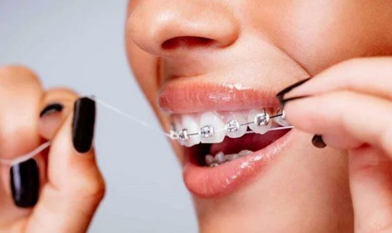 Chăm sóc răng miệng toàn diện khi niềng răng: Bí kíp "vàng" cho nụ cười rạng rỡ